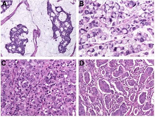 Figure 1 (A–D) Histopathological variants of colorectal cancer. (A) Mucinous adenocarcinoma characterized by abundant extracellular mucin production; (B) signet ring-cell carcinoma with prominent intracytoplasmic mucin deposition, causing displacement and molding of tumor-cell nuclei; (C) medullary carcinoma characterized by sheets of malignant cells with vesicular nuclei with prominent nucleoli and abundant eosinophilic cytoplasm (note prominent lymphocytic infiltration of the tumor tissue); (D) micropapillary adenocarcinoma with characteristic small papillary and trabecular tumor-cell clusters within stromal spaces mimicking vascular channels.