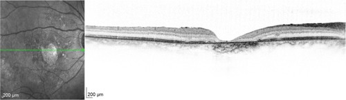 Figure 13 Stargardt’s disease showing disruption of ISel band, increased foveal pit with hyperreflectivities at the level of retinal pigment epithelium, suggestive of flecks.