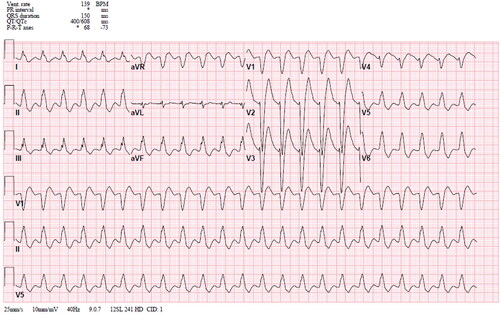 Figure 1. Electrocardiogram immediately prior to lipid emulsion bolus.