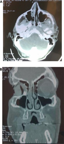 Figure 1 Preoperative CT scan showing the nasal tumor.