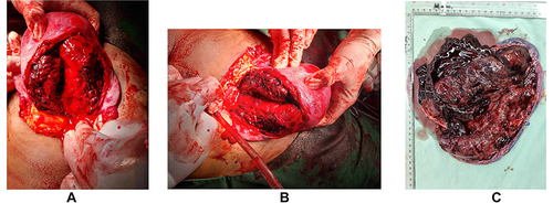 Figure 1 Uterine rupture: (a) intra-operative image of uterine rupture of the anterior side; (b) intra-operative image of uterine rupture from the lateral side; (c) gross specimen of primary uterine rupture after supravaginal hysterectomy.