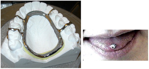 Figure 4. Left: The stainless steel frame forming the base of the encapsulation of the electronic parts. Right: The activation unit glued to the tongue.