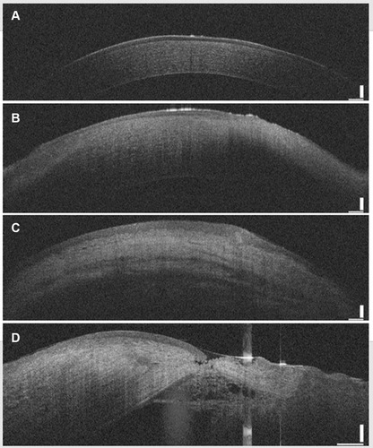 Figure 6 Representative pictures of AS-OCT examination in cornea. Cornea in healthy rabbit (A). Corneas in CTOIDD-NVCM group (B), eye drop group (C) and CTOIDD-saline group (D) on day eight, respectively.