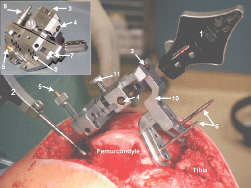 Figure 1. Femoral Pivotal™ cutting block. 1 = block tracker; 2 = femoral tracker; 3 to 5 = screws for spatial adjustment (3 is for depth of resection, 4 is for varus/valgus, and 5 is for flexion/extension); 6 = pins for temporary fixation; 7 = hole for variable angle pin; 8 = holes for pins; 9 = tracker socket; 10 = temporary block holder; 11 = release button for resection block. [Color version available online.]