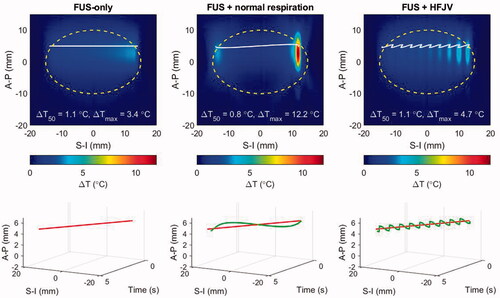 Figure 10. Temperature elevations for patient model M1 after a half-line moving beam exposure (4.7 s duration): left: no respiratory motion, center: normal respiratory motion, right: HFJV. In each panel, the coordinate system is referenced to the pancreas target center, the white line indicates the net trajectory of the HIFU beam, and the yellow dashed line encircles the treatment ‘slice’. The line plots below each colourmap indicate the beam trajectory time histories without (red) and with respiratory motion (green).