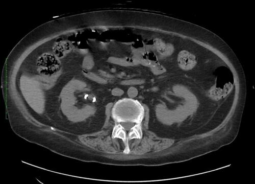 Figure 3 The coronal non-contrast-enhanced computed tomography (CT) scan (The kidneys level) revealed complete regression of the imaging findings of the disease. CT scans were taken on the 27th day of hospitalization.