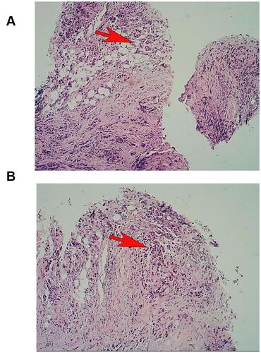 Figure 2 Right chest membranes were sent for examination. We used Hemalun eosin, hyperplastic cell nests were found in fibrotic adipose tissue (pointed by the red arrows, (A)), and specific hyperplastic cells were detected (pointed by the red arrows, (B)).