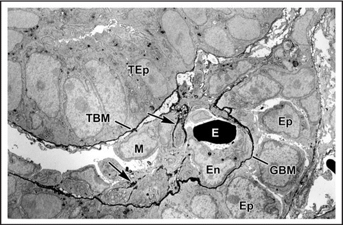 Figure 2 Electron micrograph of vascular cleft region of an S-shaped stage nephron from a newborn rat that had received an injection of anti-laminin IgG directly conjugated to horseradish peroxidase (HRP). An erythrocyte (E) is densely stained due to the peroxidatic activity of hemoglobin. HRP is present throughout the full thickness of the developing GBM separating the endothelium (En) and primitive glomerular epithelium (Ep). Some strands of basement membrane-like material (arrows) lie within the cleft near putative mesangioblasts (M). HRP is also present in developing tubular basement membranes (TBM) beneath developing tubular epithelium (TEp). Reproduced with permission (ref. Citation43).