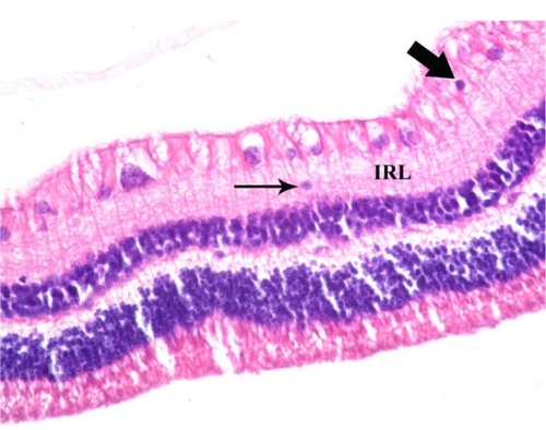 Figure 6 A photomicrograph of a section in an experimental rabbit’s retina showing a ganglion cell with pyknotic (dark) nucleus (thick arrow) and another one (thin arrow) that is displaced within the inner reticular layer (IRL). Hematoxylin and eosin staining, 400×.