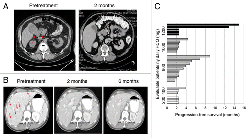 Figure 1. Antitumor activity of dose-intense TMZ and HCQ. (A) Treatment induced clearance of 2 large FDG-avid gallbladder and mesenteric metastases in a melanoma patient with brain metastases. (B) Durable near complete response of all extra CNS lesions in a metastatic melanoma patient with leptomeningeal disease. Red arrows: melanoma metastases. (C) Progression-free survival of patients.