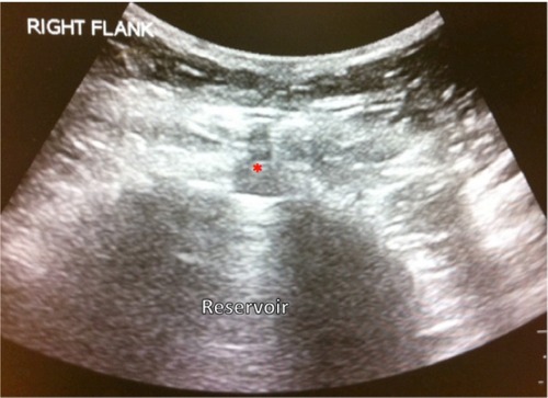 Figure 6 Ultrasound of intrathecal pump. *Indicates the reservoir fill port. Photograph courtesy of MMB.