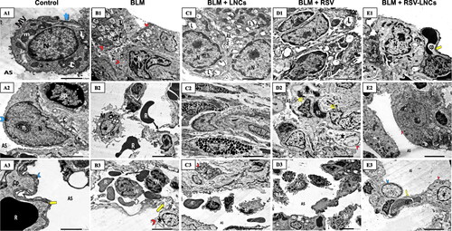 Figure 7. Representative electron photomicrographs of lung tissue in animals euthanized 3 days after BLM challenge. (A1–A3) images of the control group: (A1) A type II pneumocyte exhibits an euchromatic nucleus (N), organized lamellar bodies (L) and multiple mitochondria (m) in their cytoplasm with normal microvillus border (MV). Blue arrow; tight junction. (A2) type I pneumocyte (blue arrowhead) shows an euchromatic nucleus (N) with prominent nucleolus (n) facing the alveolar space (AS). Few amount of collagen (C) together with septal cells (sp) are seen within the inter-alveolar septum. (A3) An intact fused basal lamina (yellow arrow) is demonstrated between pneumocyte type I (blue arrowhead) and a capillary (Cp). R; RBC. (B1–B3) images of the BLM + vehicle group: (B1) shows multiple pneumocyte type II cells (red arrowheads) with increased number of lamellar bodies (L), one cell is binucleated (N). Intra-alveolar secretions (S) are noted in the lumen. (B2) shows an interrupted alveolar wall (black arrow), extravasated irregular RBCs (R) and a macrophage (M) containing multiple lysosomes and extending pseudopodia. (B3) A congested capillary containing multiple RBCs (R) and WBCs (W) with lobulated nuclei. Splitting of the basal lamina (yellow arrow) is seen. Rarefaction (star) of the cytoplasm of a pneumocyte type II (red arrowhead) is also noted. (C1–C3) images of the BLM + LNCs group: (C1) shows multiple pneumocytes type II encroaching upon the alveolar space (AS), they contain euchromatic nuclei (N), vacuolated lamellar bodies (L) and exhibit prominent microvillus border (MV). (C2) shows infiltration by multiple eosinophils (Eos) and a mast cell (Ma). (C3) shows a pneumocyte type II (red arrowhead) with a shrunken heterochromatic nucleus (N), multiple macrophages (M) and extravasated RBCs (R) within the alveolar space (AS). e; elastin fibers. (D1–D3) images of the BLM + RSV group: (D1) shows two active pneumocytes type II, one is binucleated (N), both exhibit dilated perinuclear cisternae together with dilated rER cisternae (r), vacuolated lamellar bodies (L), giant bizarre mitochondria (m) and prominent microvillus border (MV). (D2) shows multiple cells with heterochromatic irregular nuclei (N1), some are fragmented (N2) with marked narrowing of the alveolar spaces (AS) that contain exfoliated debris (d). A Pneumocyte type II (red arrowhead) shows electron lucent cytoplasm (star). (D3) shows multiple macrophages (M) within the alveolar lumen(AS). (E1–E3) images of the BLM + RSV-LNCs group: (E1) shows a type II pneumocyte with an euchromatic nucleus (N), normal microvillus border (MV) and an intact fused basal lamina (yellow arrow). Few bizarre shaped mitochondria (m) are seen. Cp; capillary. (E2) A type II pneumocyte (red arrowhead) with an euchromatic nucleus (N) and two prominent nucleoli (n) associated with increase in the number and lamellation of lamellar bodies (L).AS; alveolar space. (E3) shows preserved alveolar wall lined by normally appearing type I (blue arrowhead) and type II (red arrowhead) pneumocytes and facing patent alveolar spaces (AS). Cp; capillary. Yellow arrow; intact fused basal lamina.