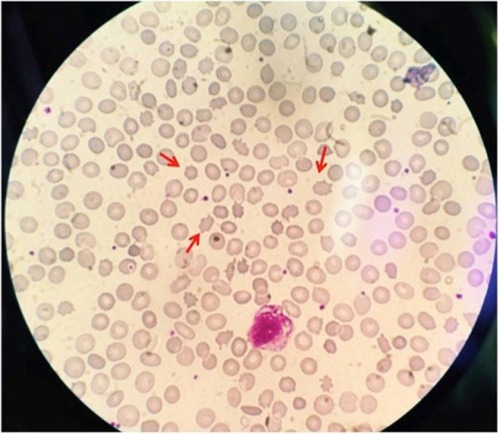 Figure 2 Peripheral blood smear showing acanthocytes (red arrows).