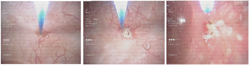 Figure 1. TULA using a diode laser with a 200-micron fiber performed via flexible cystoscopy.
