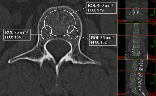 Figure 1 A 53-year old female went to hospital for low back pain, and the final diagnosis was T12 vertebral fracture. One oval ROI of 400 mm2 was placed at the middle region of axial image and two oval ROI of 75 mm2 were placed at bilateral regions of vertebral body also on the pedicle plane.