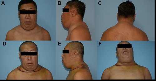 Figure 1 (A–C) A 30-year-old male patient with massive symmetrical fat accumulations in supraclavicular fossa, submental and nuchal area. The patient had limited mobility of the neck and sometimes experienced dyspnea and OSAS. He had a 30-year history of alcohol consumption without other comorbidities. (D–F) Postoperative results after surgical resection of submental and supraclavicular adipose masses. No recurrence has been identified yet.