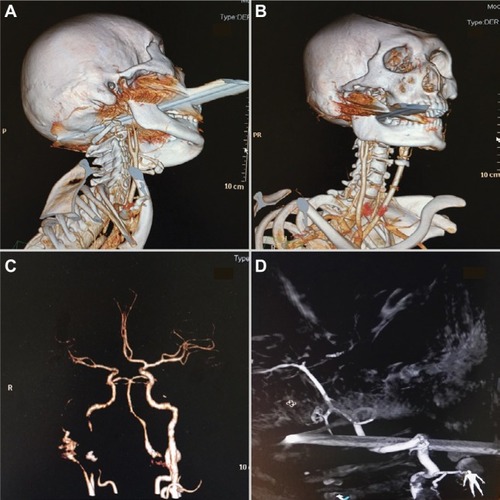 Figure 2 Digital subtraction angiography images showing the iron rod penetrating the bones but narrowly missing the right internal carotid artery (A–D).