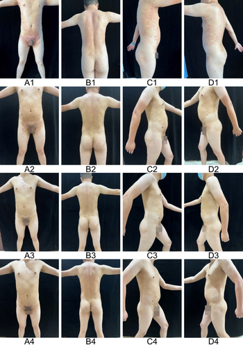 Figure 2 Skin lesions change during tofacitinib treatment. (A1–D1) Before tofacitinib treatment. (A2–D2) After one week’s treatment. (A3–D3) After six weeks of treatment. (A4–D4) In 3 months of follow-up after discontinuation of tofacitinib.