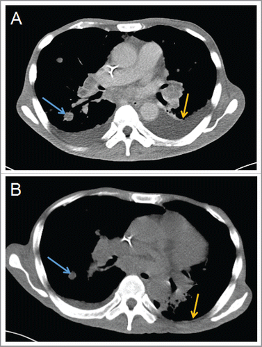 Figure 3. CT images of a 52-year-old man with bilateral pulmonary metastasis who underwent 4 courses of HANK cell immunotherapy. The blue arrows in panels (A) and(B) indicate the tumor. The yellow arrows in panels (A) and (B) indicate pleural effusion. (A) CT scan showing a tumor of approximately 2 cm diameter with bilateral pleural effusion; (B) CT scan taken at 3 months after NK immunotherapy showing that the size of the tumor was 1.4 cm and the right-sided pleural effusion had disappeared.