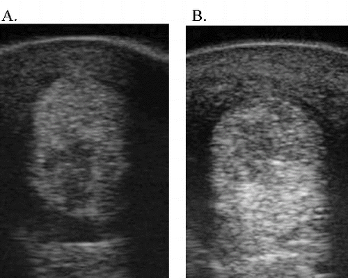 Figure 4. Ultrasound images of case 30. Lateral branch SL right front – 7.5 MHz. (A) Two weeks post-injury/moment of eUCB-MSC injection. (B) Eighteen weeks post-injury/16 weeks after eUCB-MSC injection – negative result (new lesion).