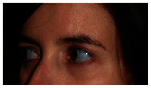 Figure 1 Blue sclera.