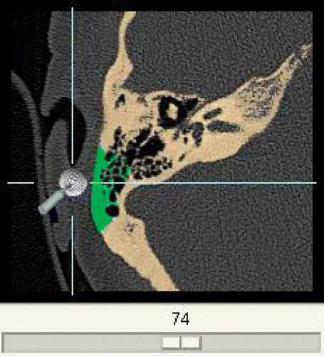 Figure 7. Additional real-time CT navigation in separate window with removed parts of the bone marked in green.