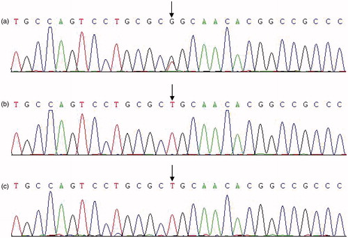 Figure 2. Mutation in UMOD gene. (a) Sequence of an affected individual; the site of the missense mutation p.Cys223Gly (c.667T✓G) is shown with an arrow. (b) Sequence of an unaffected individual. (c) Sequence of a healthy normal control.
