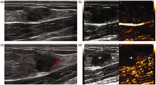 Figure 3. US and CEUS images before and 1 week after MWA in a 15-year-old girl. (a) US shows a hypoechoic tumour with a clear margin before ablation. (b) The tumour shows heterogeneous enhancement in CEUS before ablation. (c) Colour Doppler flow imaging shows blood flow signals at the margin the tumour 1 week after MWA. (d) Part of the tumour (arrow) shows enhancement in CEUS 1 week after MWA, suggesting incomplete ablation.