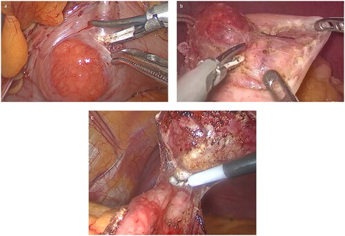 Figure 2. (a) Confirmation of the tumor location by laparoscopy. (b) Accurate dissection of the tumor along the pseudocapsule by scalpel. (c) The tumor was completely removed.