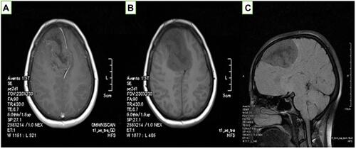 Figure 1 Brain MRI of the patient: axial plane of T1-weighted brain MRI (A) with and (B) without contrast. (C) Sagittal plane of T1-weighted brain MRI. MRI of the brain shows a low-signal, heterogeneous mass in T2 and T1 in the right frontal lobe area, extending to the right parietal area and with significant midline shift to the left. After contrast injection, a punctuate enhancement was reported.