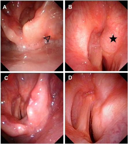 Figure 2. Electronic laryngoscopy of the patient in case 3. (A, B) The pretreatment laryngoscopy revealed lesions located in the right pyriform fossa (arrow) and right anterior ventricular band (star) with mucosal swelling and glottic stenosis. (C, D) After six months of thalidomide treatment, laryngoscopy showed notable remission of lesions in the pyriform fossa and ventricular band.