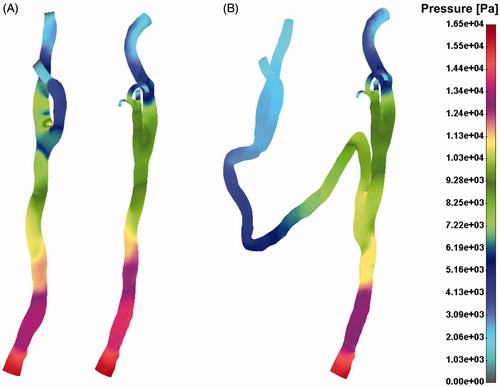 Figure 6. Pressure distribution field for the pre- (A) and post-operative (B) case.