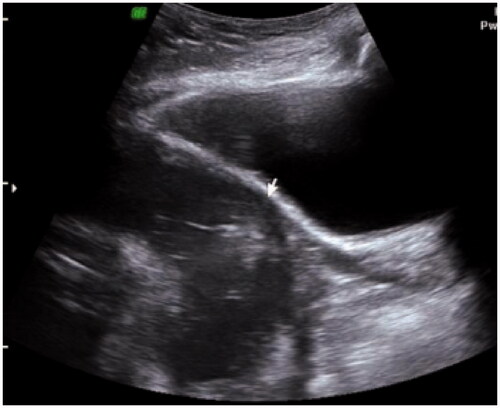 Figure 1. Absence of the muscle layer in the lower uterine segmentat the area of the caesarean section scar.