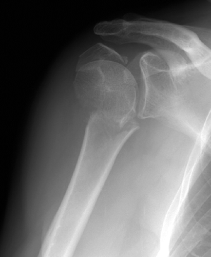Figure 1. A 3-part proximal humeral fracture in a 63-year-old man.