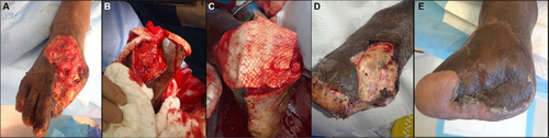 Figure 7 (A) Post-debrided foot with exposed bone. (B) Completion of transmetatarsal amputation. (C) Placement of AFS. (D) Post-op day 4 with no negative-pressure wound therapy. (E) Three weeks after grafting.