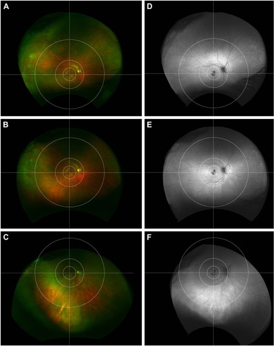 Figure 4 Patient with age-related macular degeneration and peripheral abnormalities. Ultra-widefield pseudocolor images of the left eye demonstrate juxtafoveal geographic atrophy and macular drusen, partially extending into the perimacular region. There are a few drusen, mostly in the nasal far periphery, but also inferior along the border of mid- and far periphery (A–C). Corresponding autofluorescence images demonstrate brisk hypoautofluorescence juxtafoveally with adjacent hyperautofluorescence. There is hyperautofluorescence, which extends into the temporal perimacular as well as speckled hyperautofluorescence, mostly nasally and inferiorly (D–F). Upgaze (A and D); primary gaze (B and E), downgaze (C and F).