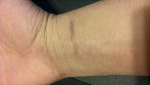 Figure 3 Photograph of completely healed wrist wound taken 2 months later.