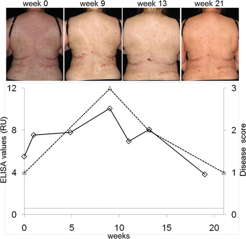 Figure 10. Correlation of serum levels of IgG antibodies against type VII collagen with disease severity. Serum autoantibody levels were detected by ELISA (diamonds; Euroimmun, Lübeck, Germany), disease activity was measured by a clinical score (triangles; 3, >10 lesions; 2, 4–10 lesions; 1, 1–3 lesions; 0, no lesions). Representative clinical pictures during the course of the disease are shown at the top.