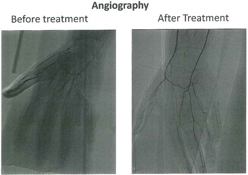 Figure 1. Angiography before and after treatment. Angiographic images showing the status of peripheral vessels in fingers. The pre-treatment picture show open arteries in the right forearm. The digital arteries in the hand are displayed extraordinary gracile. The blood-flow in the arteries are reduced, even if the fingers are stimulated with mild heat or undergoing exercise. The post-treatment images still show reduced peripheral vascularisation, however, the digital arteries are more vasodilated and less gracile compared with the pre-treatment display.