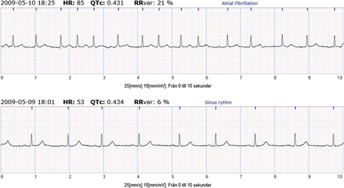 Figure 1. Example of sinus rhythm (bottom) and AF (top) registration using the intermittent ECG device.