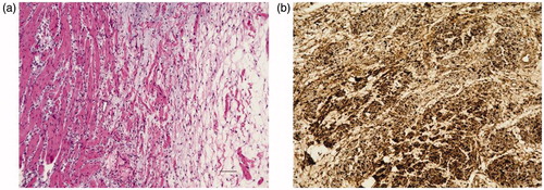 Figure 4. Histopathological examination. (a) Compact spindle cells arranged in short bundles, composed of focal hypercellular (Antoni-A) areas and hypocellular areas (Antoni-B) with no malignant findings (H–E). (b) The tumor cells are positive for S-100 (Immunohistochemistry). Scale bar: 100 μm in (a) and (b).