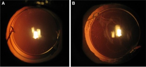 Figure 4 The slit-lamp retroillumination photo of the right eye (A) with the ring and left eye (B) without the ring 36 months postoperatively in the same patient.