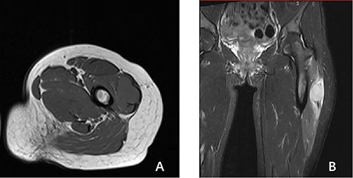 Figure 3 A 24-year-old female patient with a differentiated soft tissue sarcoma in her left thigh. (A) T1-weighted image shows a non-fat signal soft tissue mass with a relatively distinct boundary on the outer side of the left thigh, predominantly displaying homogeneous low signal intensity. (B) The fat-suppressed T2-weighted image shows predominantly homogeneous high signal non-fat areas, with the tumor infiltrating along muscle fascicles and exhibiting irregular edges.