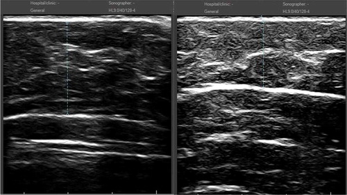Figure 4. (a) Ultrasound image for 53-year-old female subject (Figure 2) prior to treatment. (b) 16-week follow-up: measurement showed 7.0 mm reduction (from 21.2 mm at baseline to 14.2 mm at follow-up).