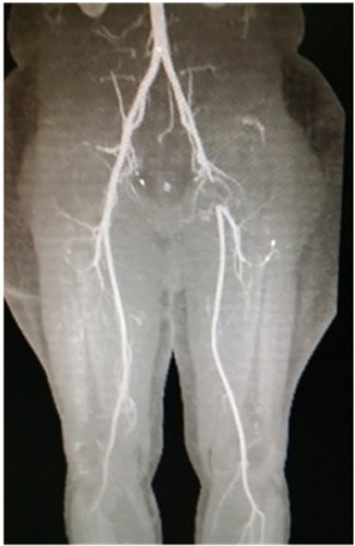 Figure 1 CT angiogram showing complete occlusion of left common femoral artery.