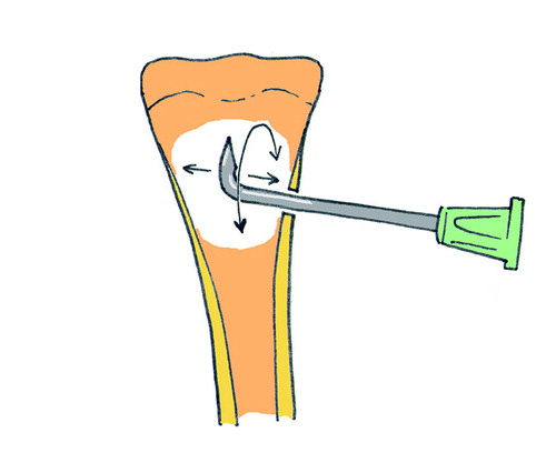 Figure 1. The method for creating a fracture in the cancellous bone of the metaphyseal marrow. The proximal tibia is seen in anterior aspect. The growth plate is drawn as a waving line. A bent needle was inserted below the growth plate and rotated to traumatize the metaphyseal bone.