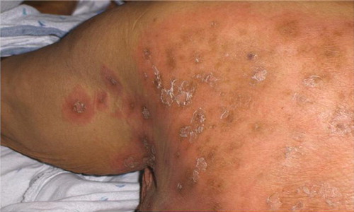 Figure 1 SJS in a patient on carbamazepine: Skin lesions demonstrating characteristic diffuse erythematous macules seen in SJS. The macules are typically targetoid with necrotic centers, and overlying flaccid blisters.