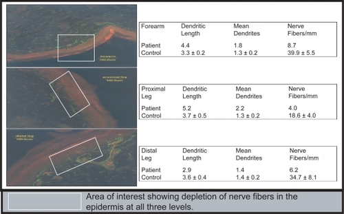 Figure 1 Pan-reduction of intrapidermal nerve fiber (IENF) density in the skin of the forearm, proximal leg, and distal leg with PGP 9.5 (Protein Gene Product) used as a fluorescent marker for IENF.