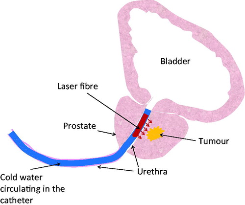 Figure 1. Schematic diagram of laser photothermal therapy in treating prostatic cancer. A catheter with an embedded laser fibers is inserted through the prostatic urethra, supported by cooling water circulating inside the catheter to protect the urethra from overheating. Laser energy is emitted from the laser fiber to reach the tumor.