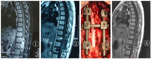 Figure 3 T9–12 ependymoma grade III of the patient: (1) preoperative enhancement; (2) postoperative enhancement two weeks after surgery; (3) internal fixation during surgery; (4) postoperative enhancement two years after surgery.